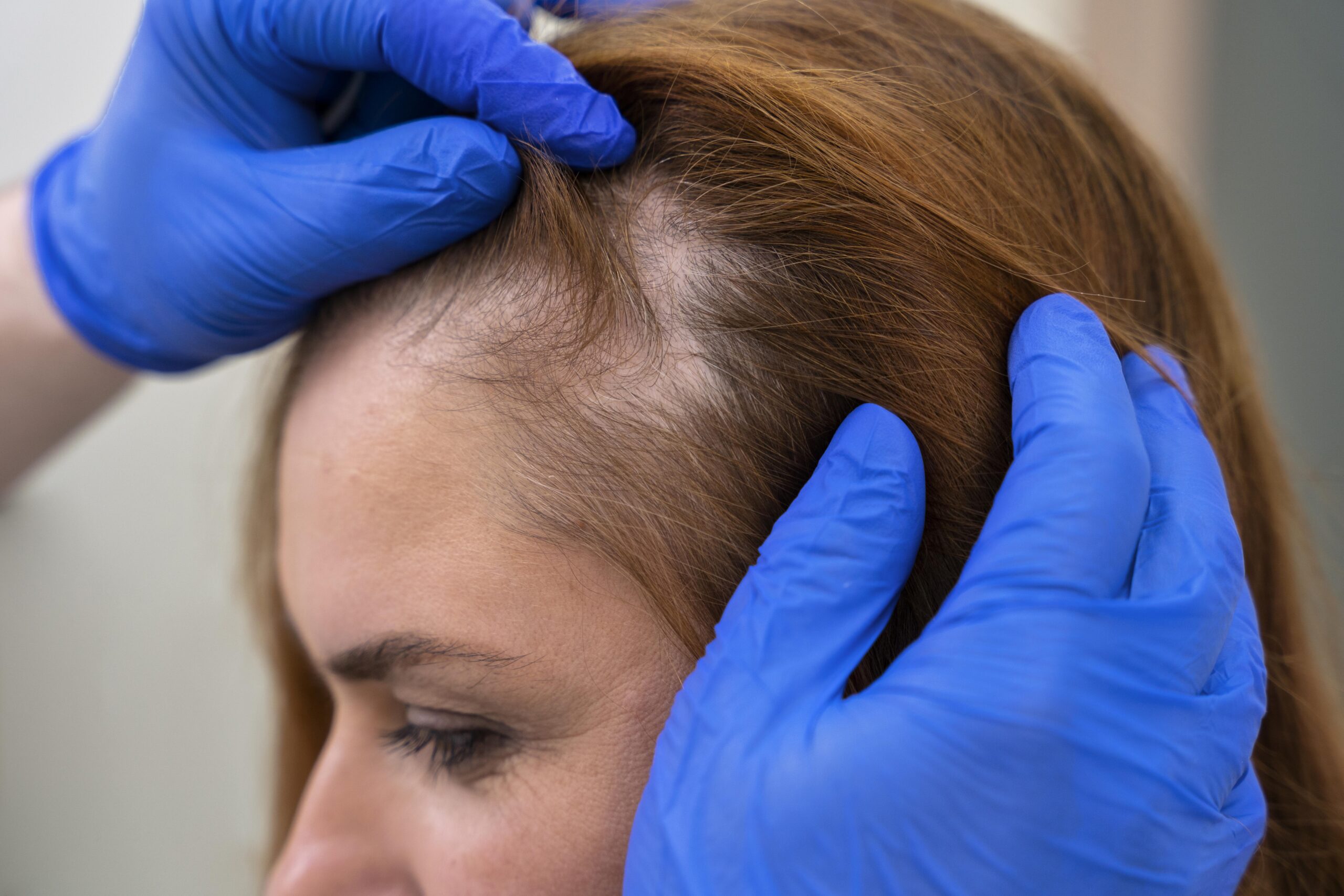 Hair loss clinic in Ghaziabad